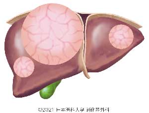 Liver_cyst01