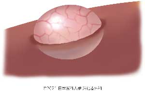 Liver_cyst02
