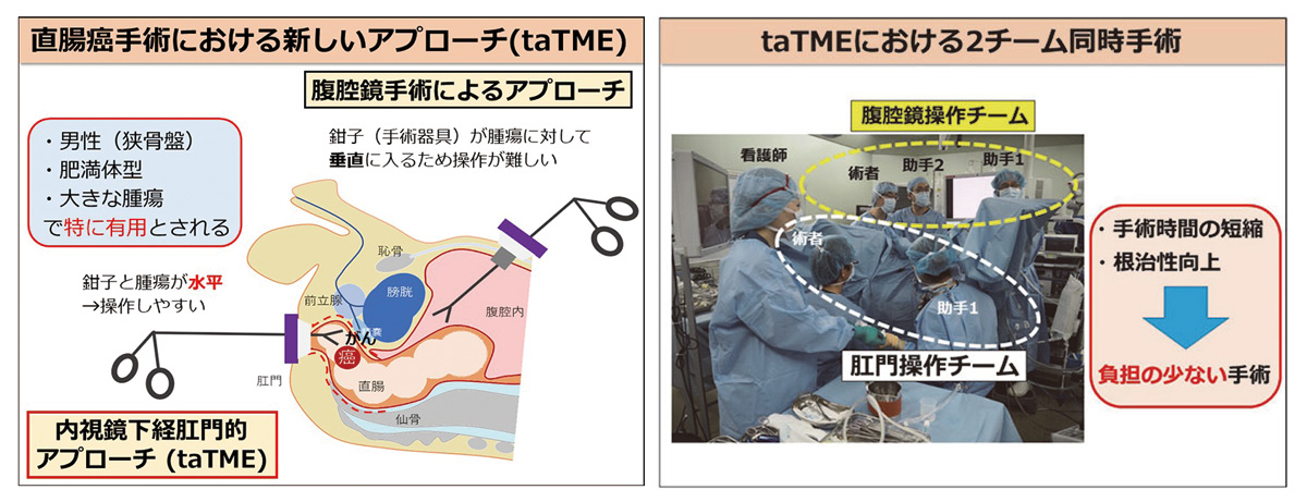 直腸手術における新しいアプローチ（taTME）。taTMEにおけるチーム同時手術